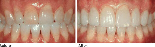 cs-veneers