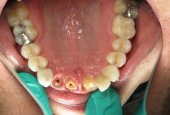 implant-crowns-case-study-before-and-after