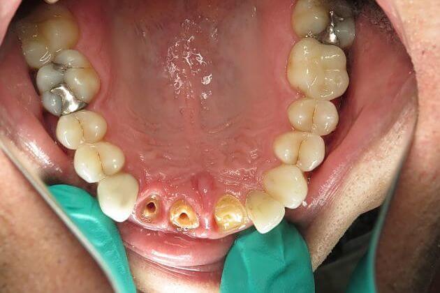 implant-crowns-case-study-before-and-after