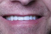 Dental Implant Crowns_CaseStudy_After