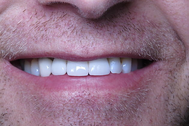 Dental Implant Crowns_CaseStudy_After