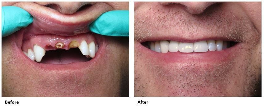 dental-implants-case-study-before-and-after