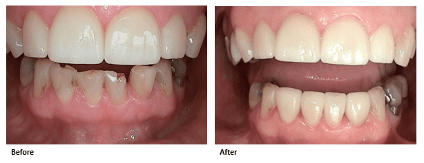 dental-crown-before-and-after-park-dental