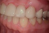 dental-crown-before-and-after-park-dental