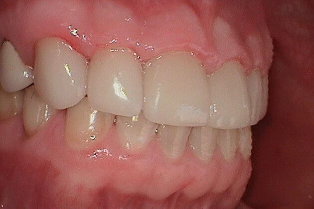 dental-crown-before-and-after-park-dental
