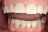 dental-crown-before-and-after-park-dental-case-study