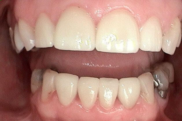 dental-crown-before-and-after-park-dental-case-study