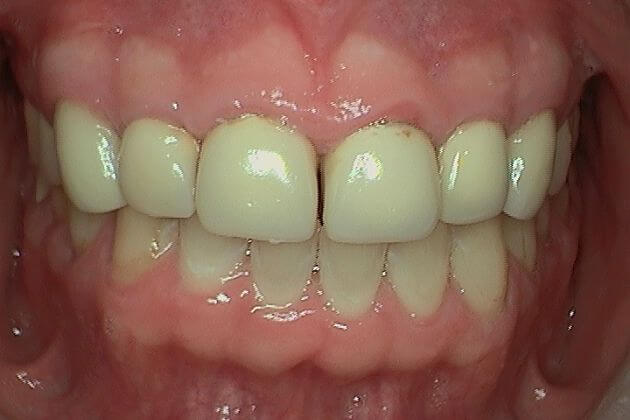 Dental-crown-before-and-after-park-dental