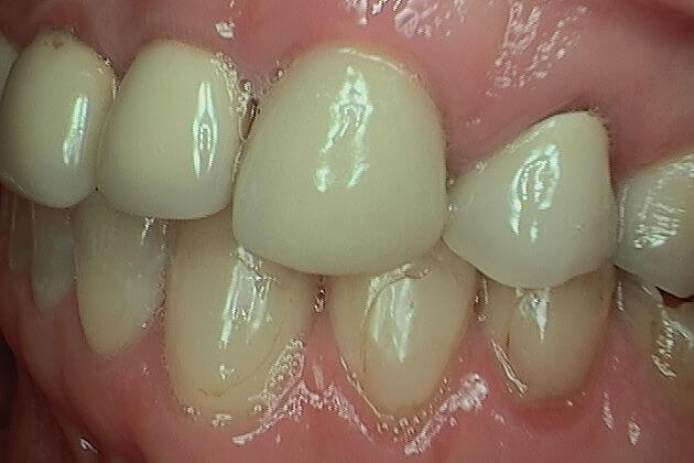 Dental-Crown-Before