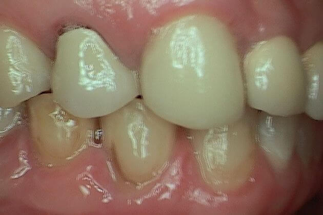 Dental-Crown-Before